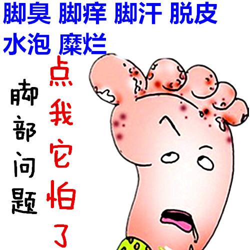 手足癣的常见症状有哪些